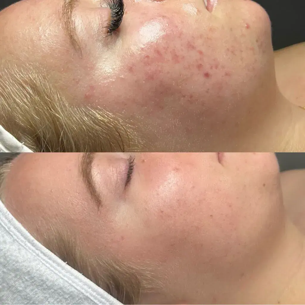 Trattamento Anti Acne