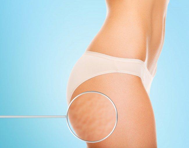 Trattamenti corpo cellulite